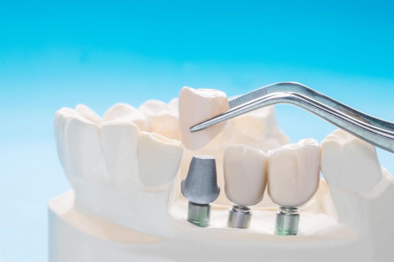 dental implants in wenatchee